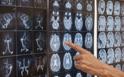 Lanzaron la cirugía robótica para el tratamiento del accidente cerebrovascular