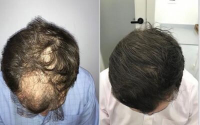 Injerto capilar con tecnología robótica