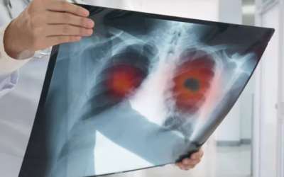 Cómo funciona el pequeño robot quirúrgico que podría revolucionar el tratamiento del cáncer de pulmón