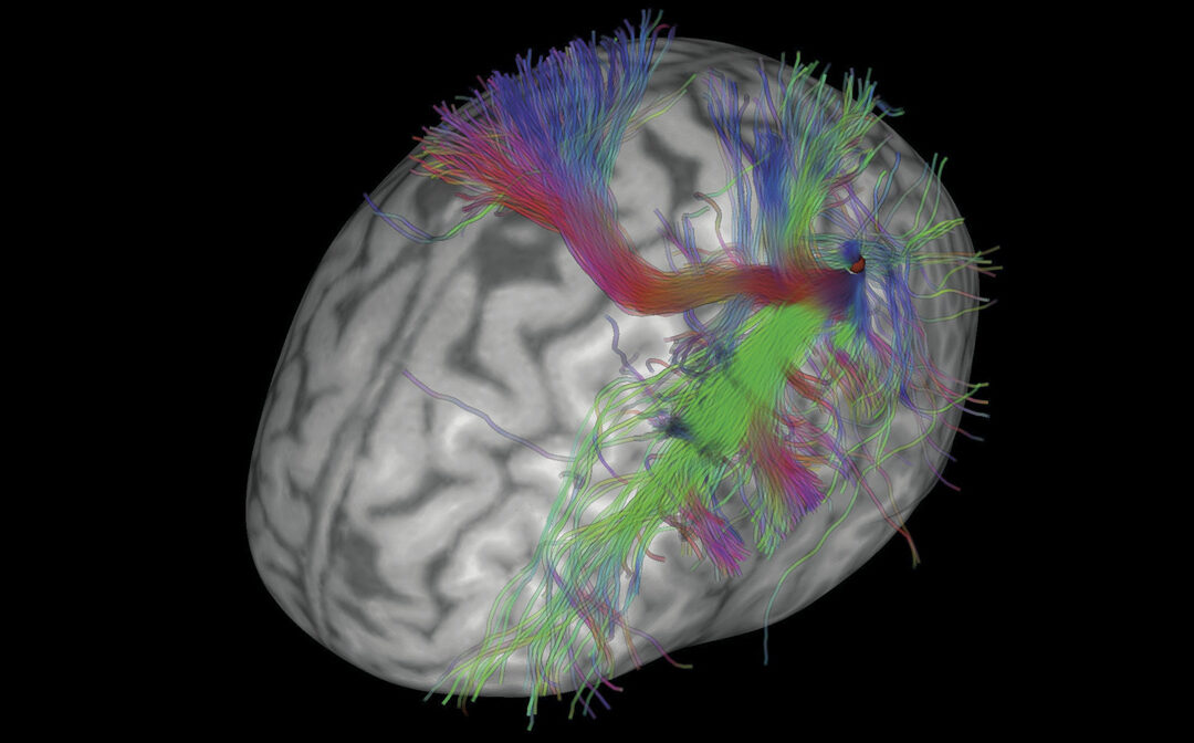 Una plataforma robótica dota de mayor precisión al tratamiento mediante la estimulación magnética transcraneal