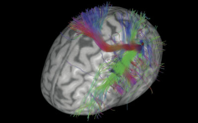 Una plataforma robótica dota de mayor precisión al tratamiento mediante la estimulación magnética transcraneal